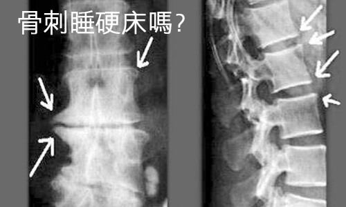 有骨刺就要睡硬床嗎?
